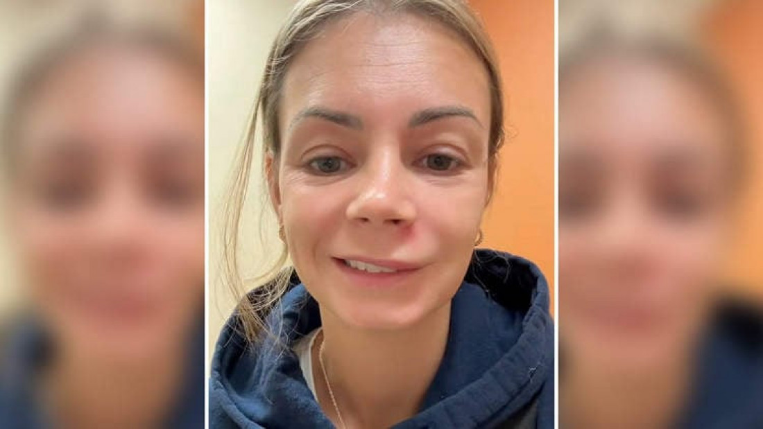 Opasnosti ceđenja bubuljica u ‘trouglu smrti’ lica
