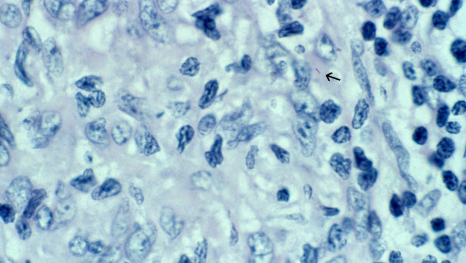 Koji su simptomi gube/lepre?