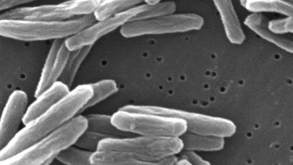 Tuberkuloza i dalje ozbiljan problem u Evropi